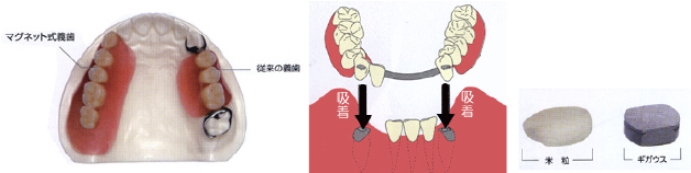 マグネット式義歯をご存知ですか？