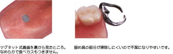 マグネット式義歯をご存知ですか?