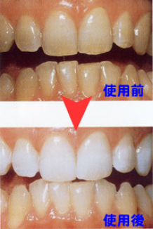 歯を白くしたい方！ホワイトニングをしたい方